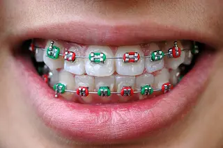 braces for you