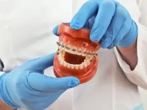 Braces for Your Teeth