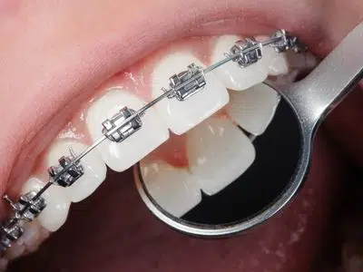 Braces for Your Teeth