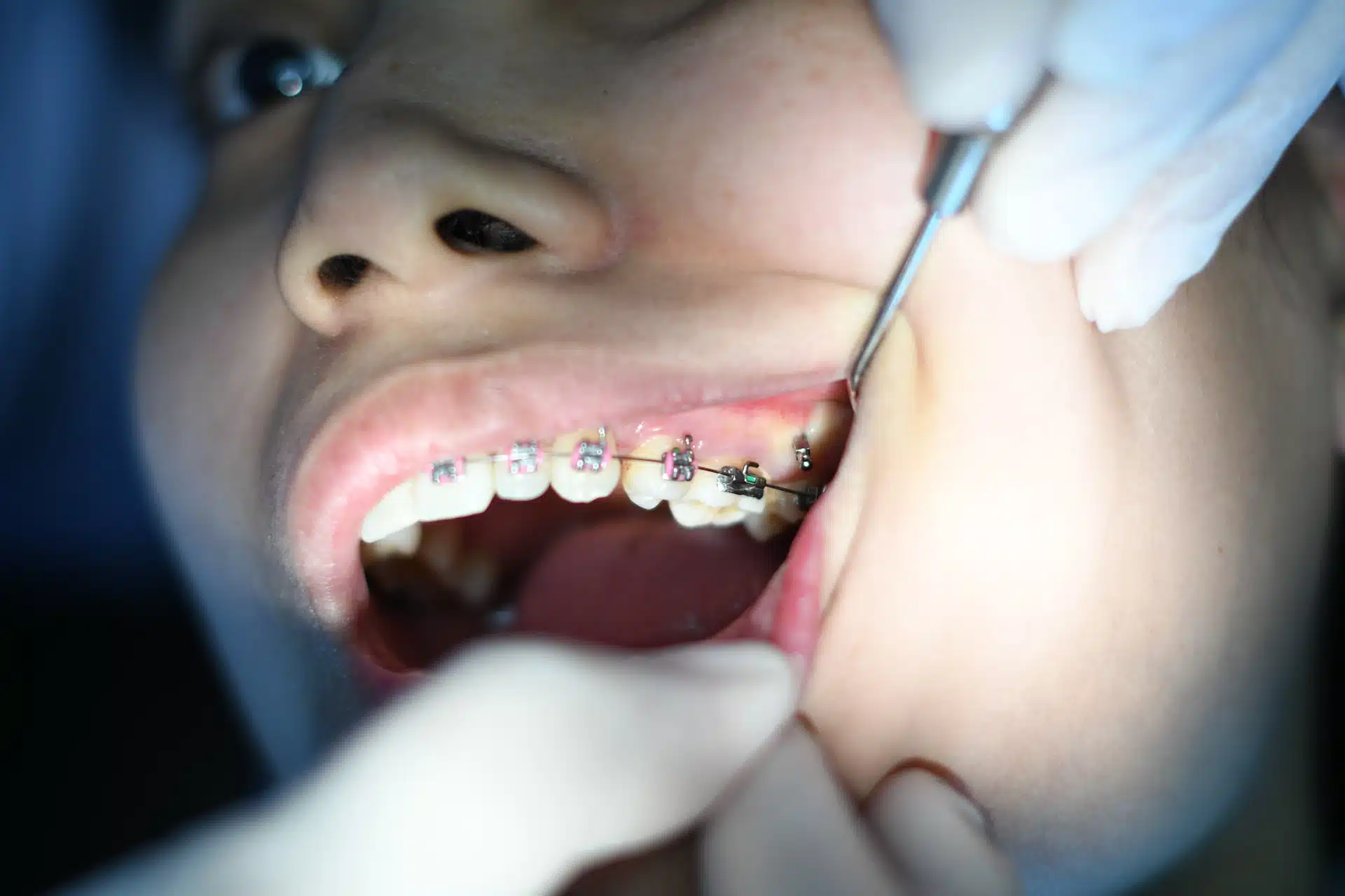 Teeth Shifting