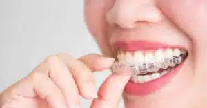 Benefits of Invisalign