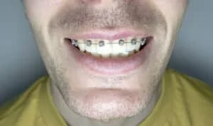 In-ovation C and R Braces in Centralia