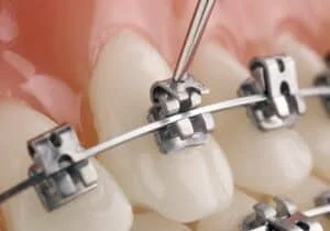 Orthodontic Treatment Options Centralia WA