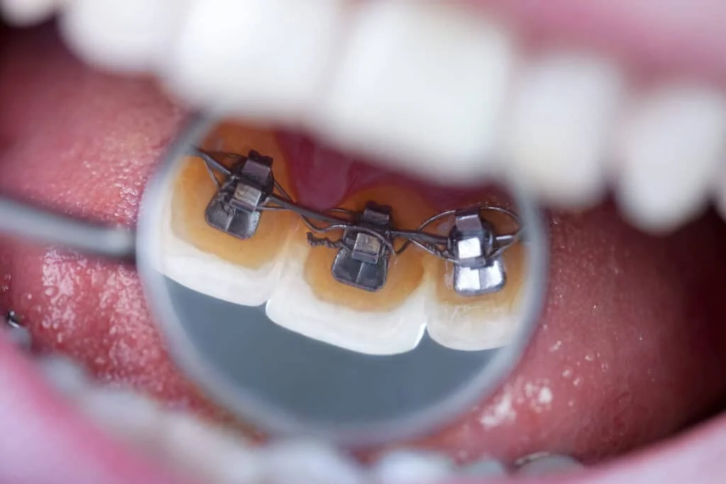 MTM No Trace Invisible Braces for a Natural Smile