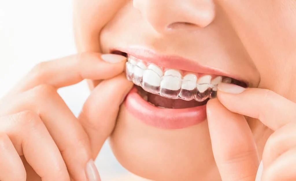 Person inserting clear aligner as part of Invisalign Centralia WA treatment