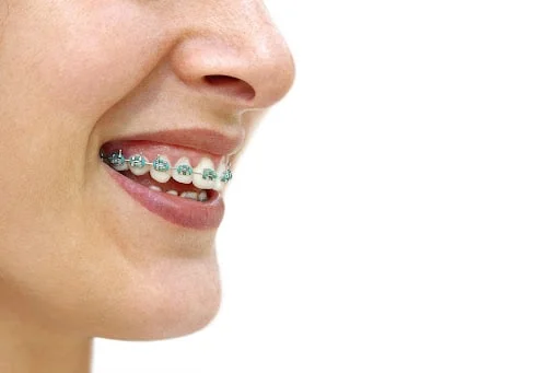 Side profile of a patient smiling while wearing braces during life with braces