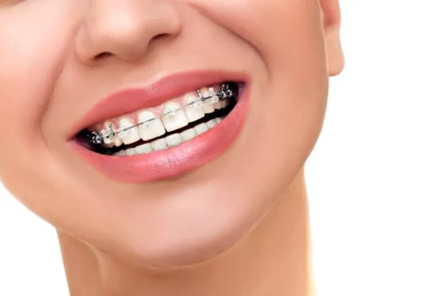 Close-up of an adult smile showing self-ligating braces for adults on upper teeth