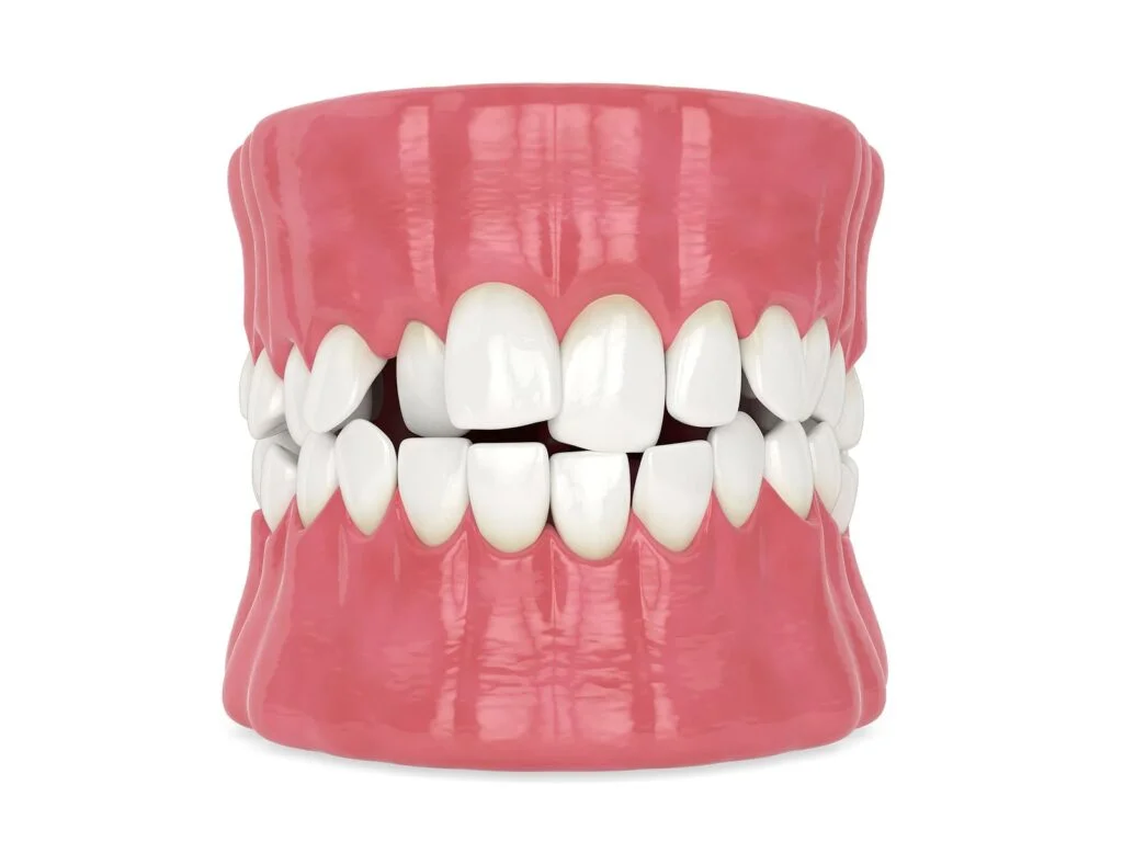 3d model of mild spacing issues that short-term orthodontics may help with